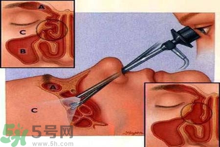 鼻竇炎的護理措施？鼻竇炎的飲食護理？