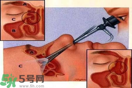 鼻竇炎的高發(fā)人群？如何預防鼻竇炎？