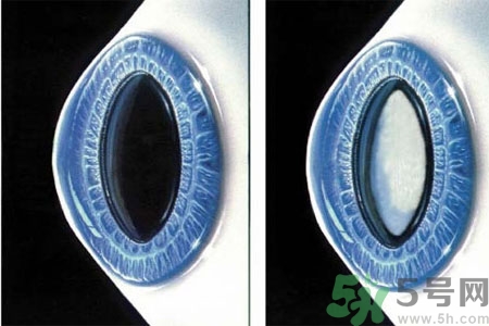 白內(nèi)障是什么？白內(nèi)障的癥狀有哪些？