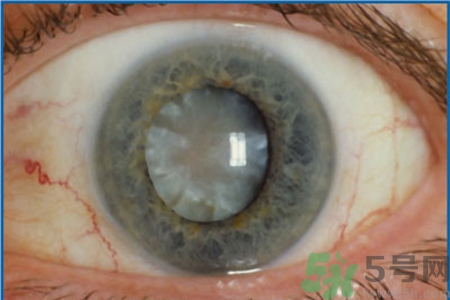 白內(nèi)障治療方法是什么？白內(nèi)障可以用什么藥物治療？