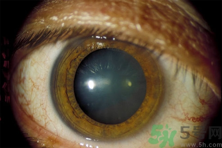 白內(nèi)障治療方法是什么？白內(nèi)障可以用什么藥物治療？