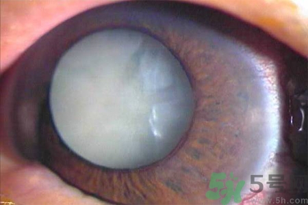 白內(nèi)障治療方法是什么？白內(nèi)障可以用什么藥物治療？