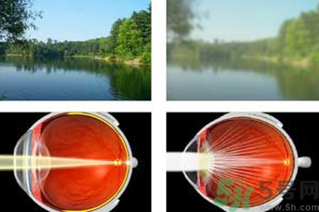 白內障的高發(fā)人群有哪些？如何預防白內障？