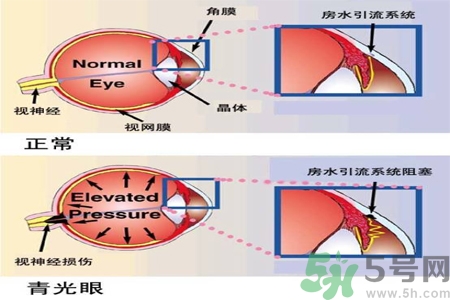 青光眼的護(hù)理措施有什么？青光眼的飲食護(hù)理有哪些？