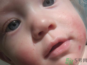 寶寶長奶蘚怎么回事？寶寶長奶蘚怎么辦？