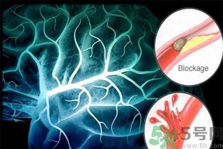 腦出血的發(fā)病因素是什么？腦出血的并發(fā)癥有哪些？