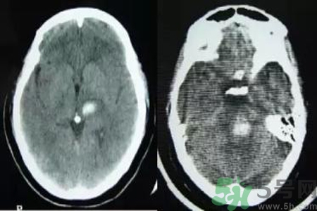 腦出血的發(fā)病因素是什么？腦出血的并發(fā)癥有哪些？