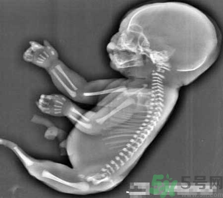 媽媽懷上人魚寶寶 什么是美人魚綜合癥？