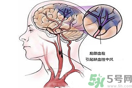 腦出血的治療方法是什么？腦出血可以用哪些藥物治療？