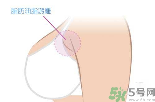 副乳是什么？副乳的危害