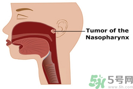 鼻咽癌的日常措施是什么？鼻咽癌注意的飲食有哪些？