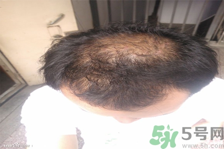 脫發(fā)的措施有什么？脫發(fā)的注意飲食有哪些？