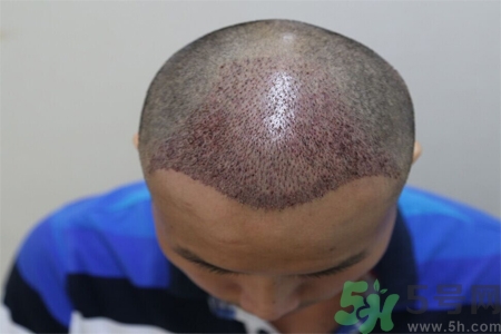 脫發(fā)的原因是什么？脫發(fā)會引發(fā)什么疾病？