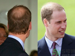 男人禿頂是什么原因？男人禿頂怎么辦？