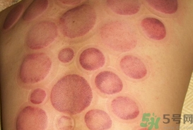 拔火罐可以減肥嗎?拔火罐能減肥嗎? 拔火罐可以減肥嗎?拔火罐能減肥嗎?