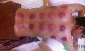 拔火罐可以減肥嗎?拔火罐能減肥嗎? 拔火罐可以減肥嗎?拔火罐能減肥嗎?