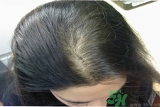 脫發(fā)的治療方法是什么？脫發(fā)的藥物治療有哪些？