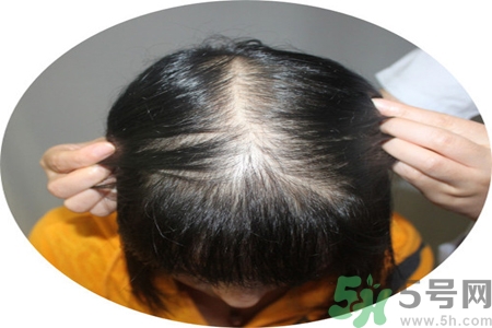 脫發(fā)的治療方法是什么？脫發(fā)的藥物治療有哪些？