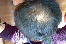 脫發(fā)的高發(fā)人群有哪些？如何預(yù)防脫發(fā)？