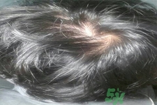 脫發(fā)的高發(fā)人群有哪些？如何預(yù)防脫發(fā)？