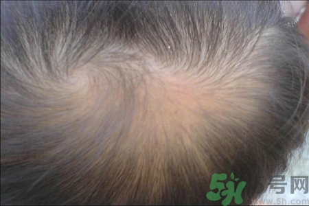 脫發(fā)的高發(fā)人群有哪些？如何預(yù)防脫發(fā)？