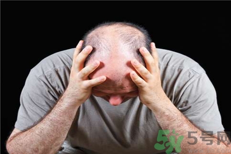 脫發(fā)的高發(fā)人群有哪些？如何預(yù)防脫發(fā)？