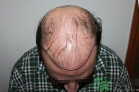 脫發(fā)會遺傳嗎？脫發(fā)遺傳可以治療嗎？