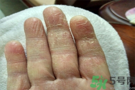 手足癬是什么？手足癬癥狀有什么？