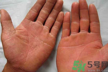 手足癬是什么？手足癬癥狀有什么？