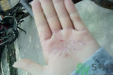 引起手足癬的主要原因？手足癬會(huì)引發(fā)什么疾病？