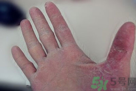 引起手足癬的主要原因？手足癬會(huì)引發(fā)什么疾??？