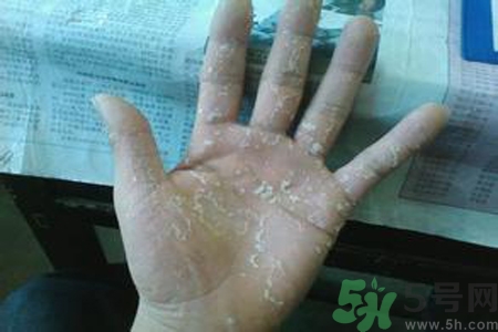 引起手足癬的主要原因？手足癬會(huì)引發(fā)什么疾??？