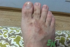 手足癬的治療方法？治療手足癬可以用什么藥？