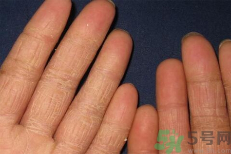 手足癬的治療方法？治療手足癬可以用什么藥？