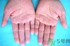 手足癬的治療方法？治療手足癬可以用什么藥？