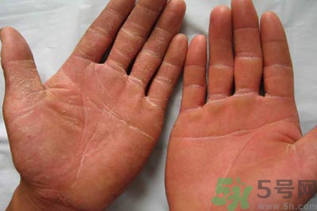 手足癬的治療方法？治療手足癬可以用什么藥？