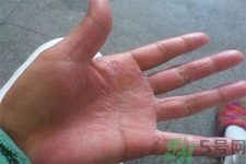 手足癬的易發(fā)人群有哪些？如何預防手足癬？