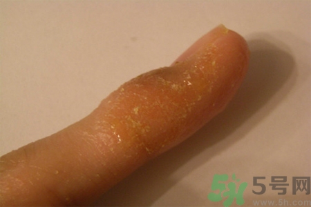 手足癬的易發(fā)人群有哪些？如何預防手足癬？