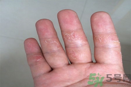 手足癬的易發(fā)人群有哪些？如何預防手足癬？