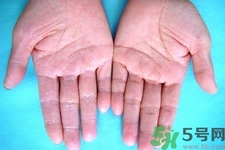 手足癬預(yù)防措施需要注意什么？手足癬飲食要注意哪些？