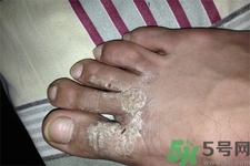 手足癬預(yù)防措施需要注意什么？手足癬飲食要注意哪些？