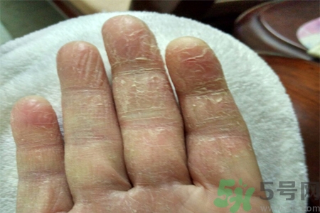 手足癬會傳染嗎？手足癬的傳播途徑有哪些？