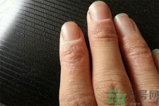 手足癬會傳染嗎？手足癬的傳播途徑有哪些？