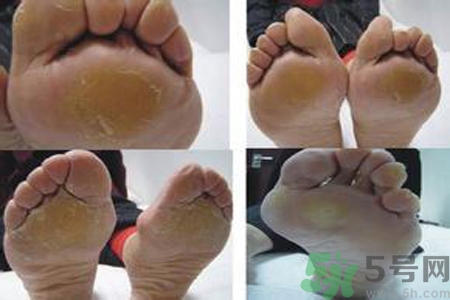 手足癬會傳染嗎？手足癬的傳播途徑有哪些？