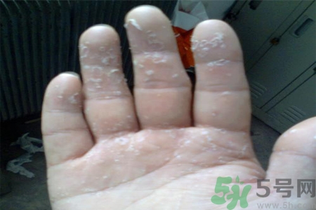 手足癬會傳染嗎？手足癬的傳播途徑有哪些？