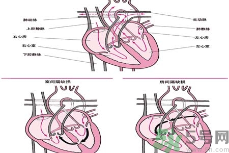 先天性心臟病是什么？先天性心臟病的癥狀有哪些？