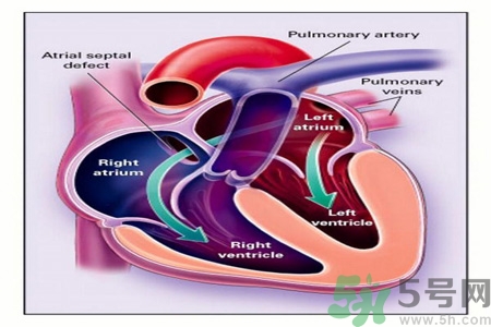 先天性心臟病發(fā)病原因是什么？