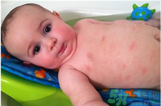 寶寶秋季過敏性皮炎是什么引起的？寶寶秋季過敏性皮炎的預(yù)防及治療