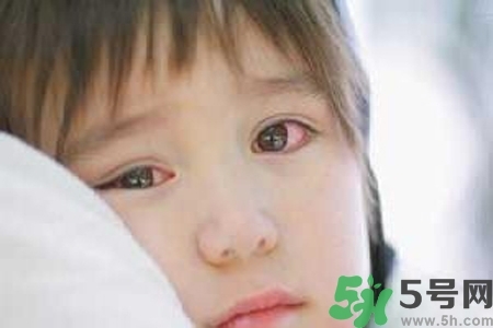 寶寶為什么會(huì)感染紅眼??？寶寶患紅眼病如何治療？