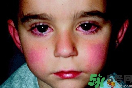 寶寶為什么會(huì)感染紅眼病？寶寶患紅眼病如何治療？